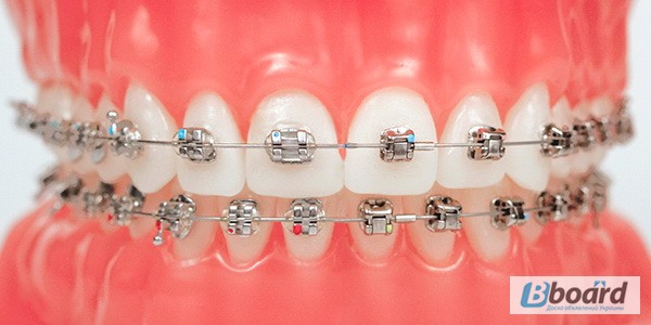 Фото 5. Стоматолог - Ортодонт. Все виды брекетов. Выравнивание зубов