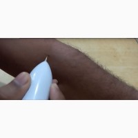 Лазерная ручка Mole Removal для удаления тату, бородавок и т.д