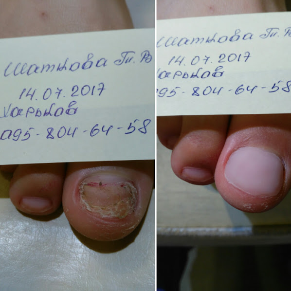 Фото 5. Комплексный уход за стопой, решение проблем грибка ногтей и кожи Харьков