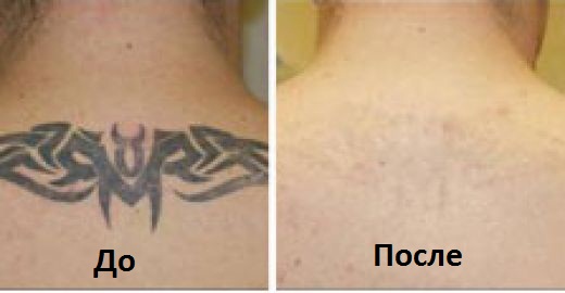 Фото 2. Удаление неудавшегося или старого татуажа