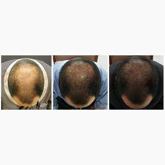Ускорение роста волос, методом мезотерапии-спасение для ваших волос